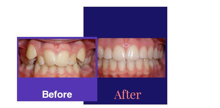 periodontitis before and after