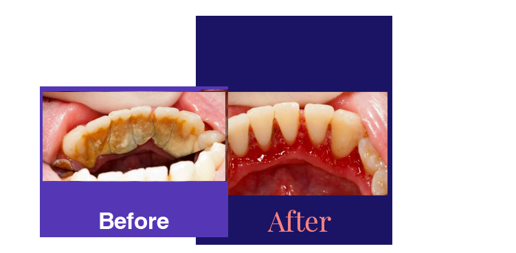 Prophylaxis before and after