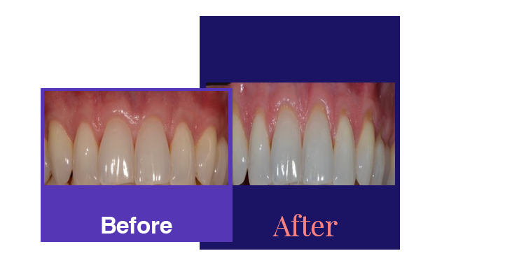 Laser Treatment before and after