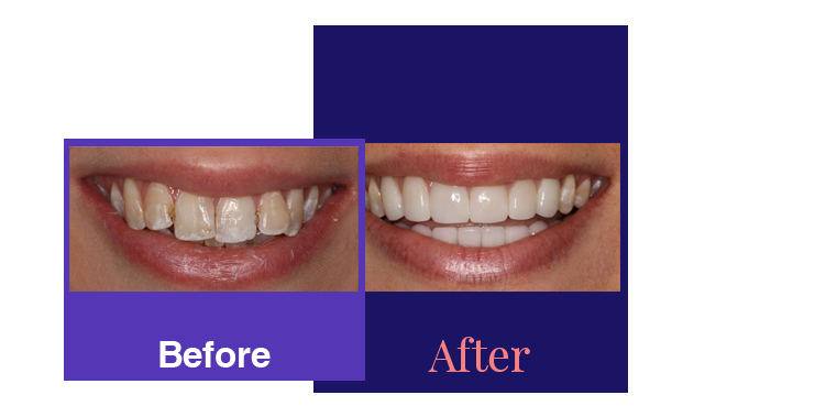 dental crowns before and after