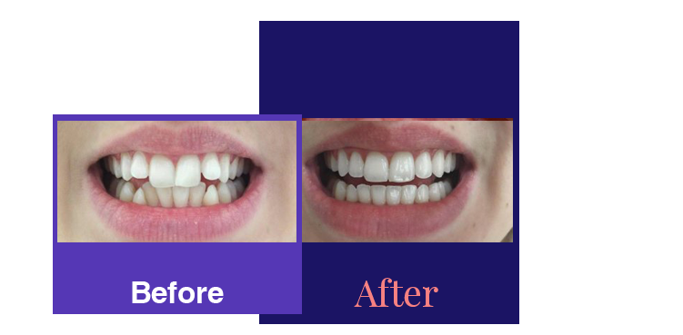 invisalign before and after