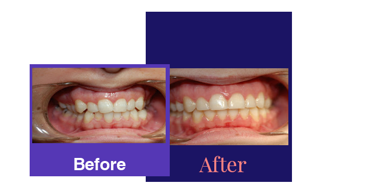 pedodontie pedodontics before and after